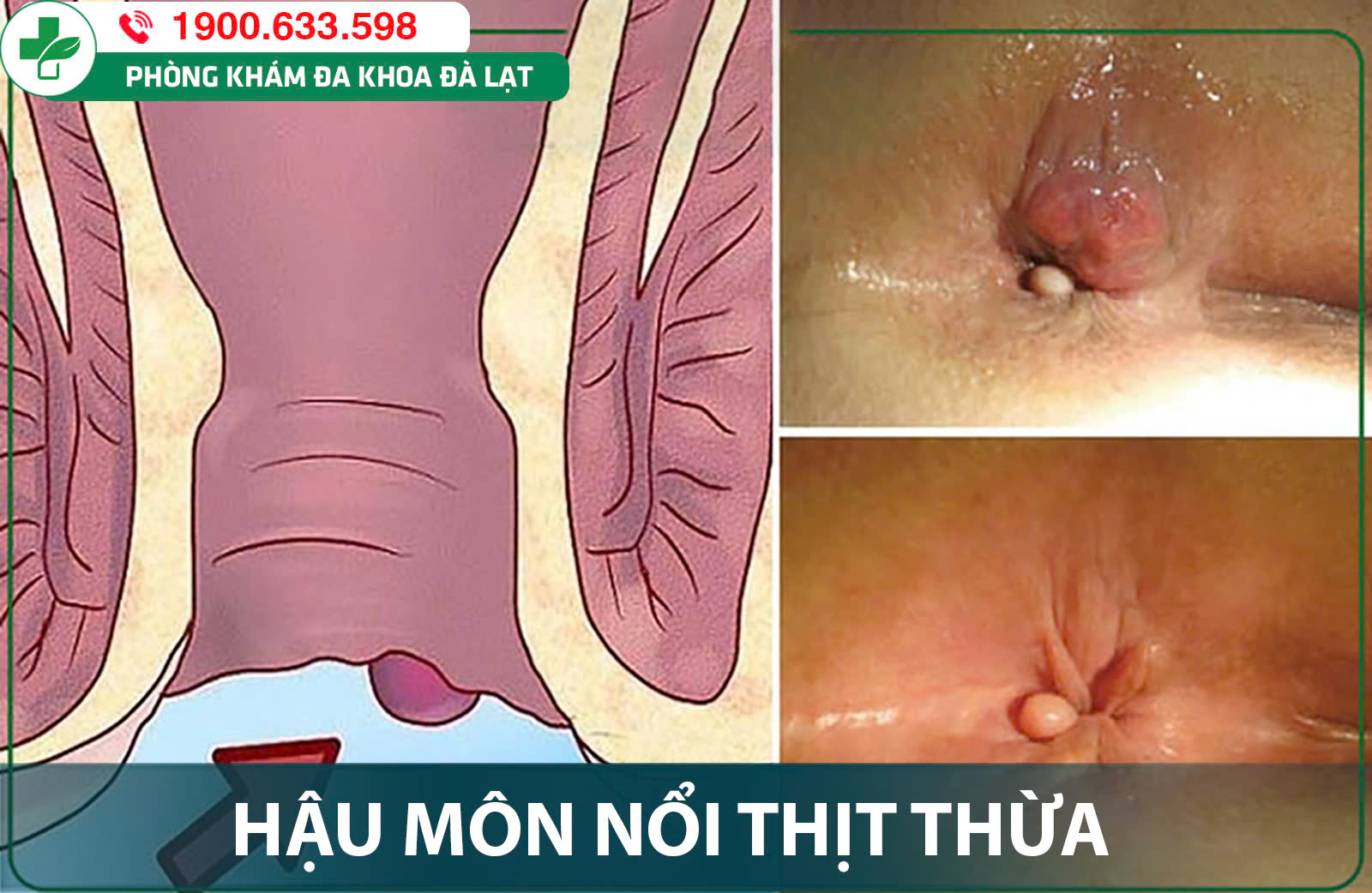 Hậu môn nổi mụn thịt: Nguyên nhân, cách điều trị hiệu quả